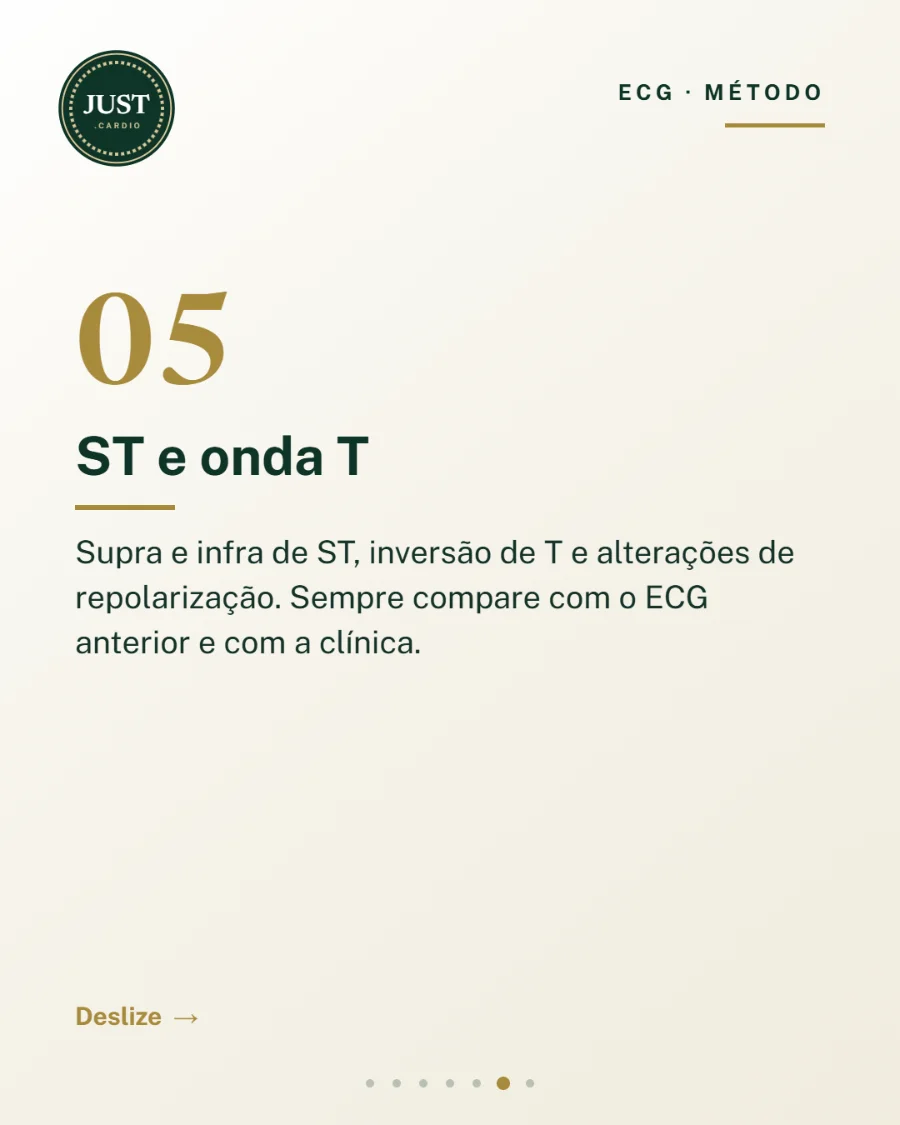 Passo 5 da leitura do ECG: segmento ST e onda T