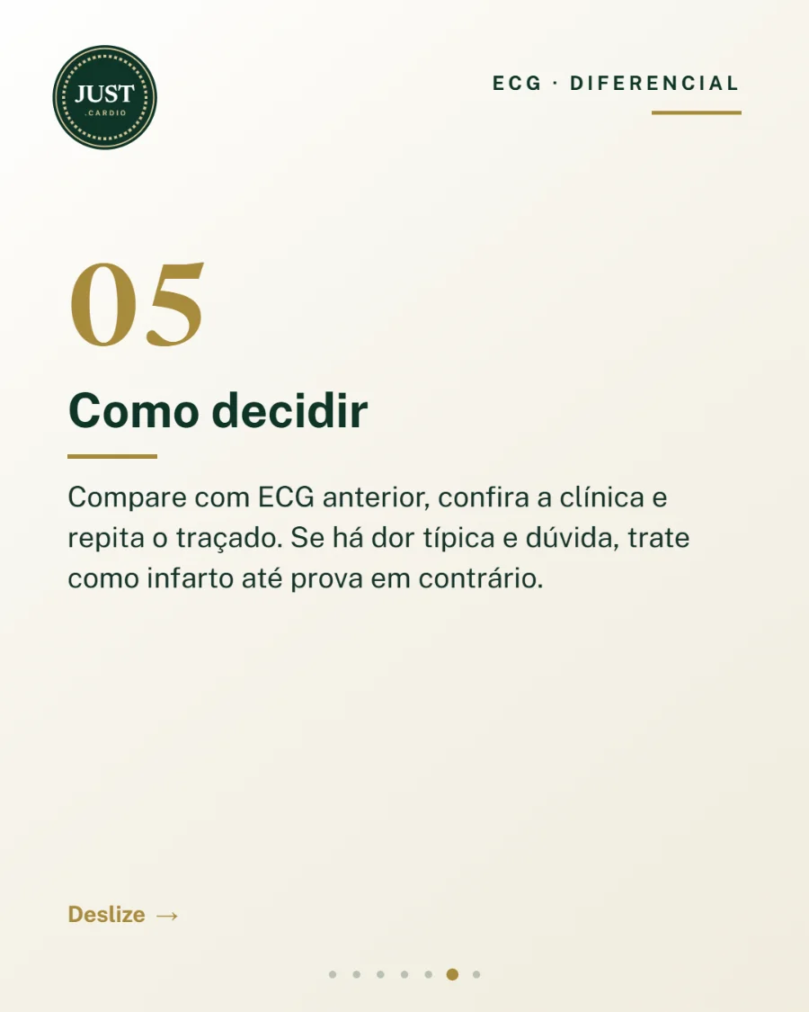 Como decidir diante de supra de ST: comparar com ECG anterior, clínica e traçados seriados