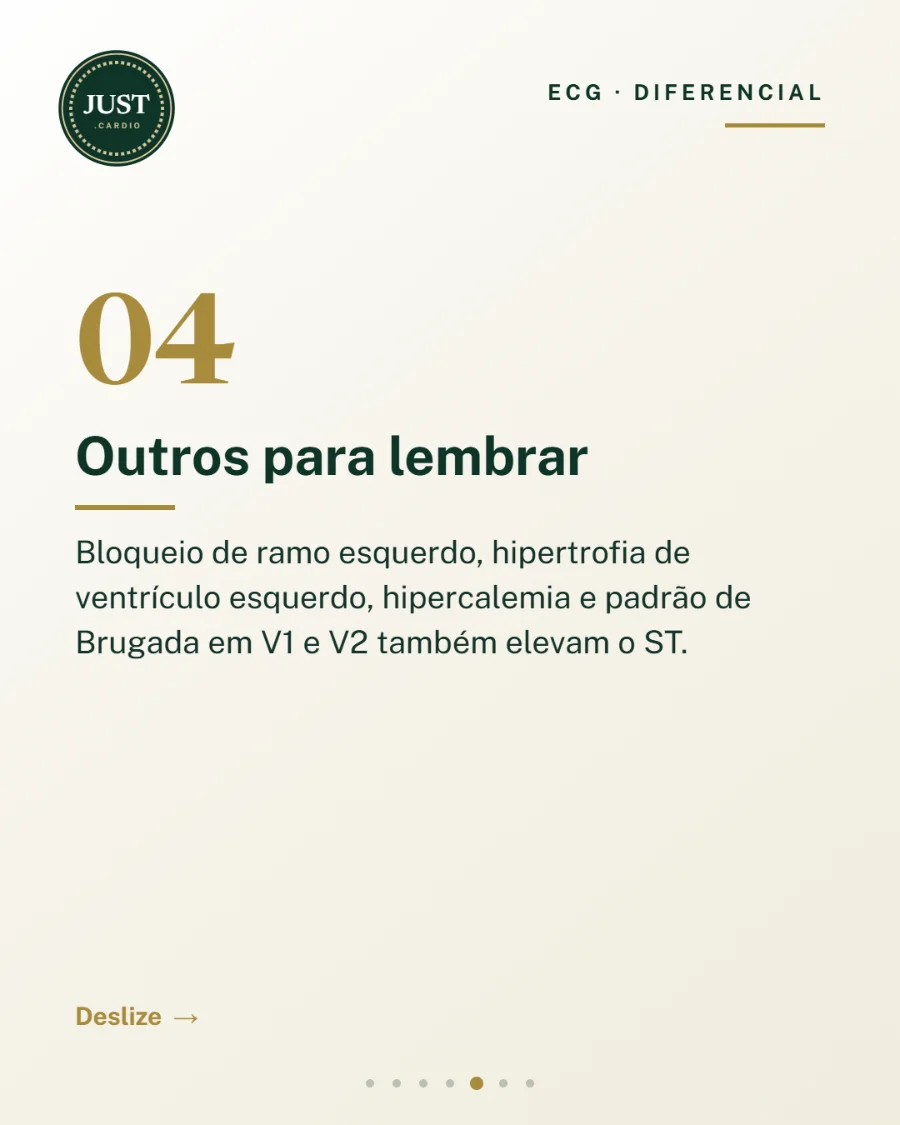 Outras causas de supra de ST: bloqueio de ramo esquerdo, hipertrofia ventricular esquerda, hipercalemia e Brugada