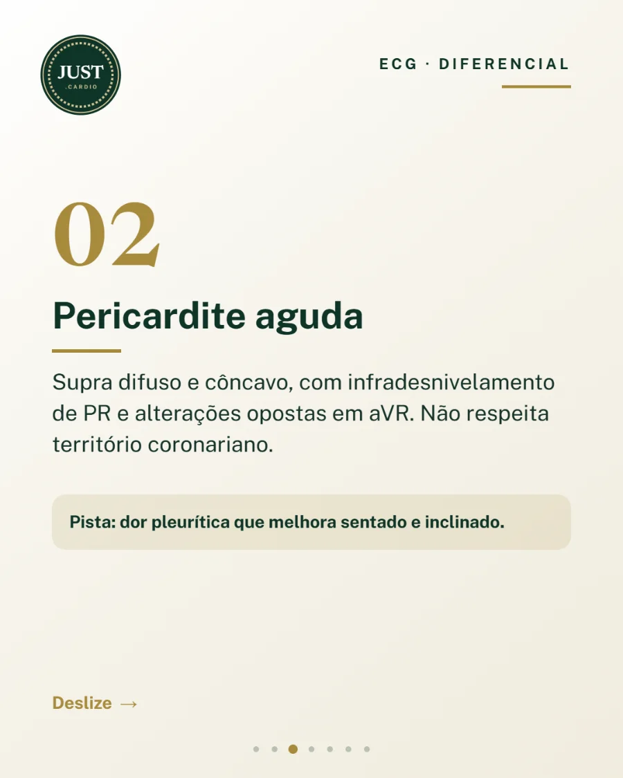 Pericardite aguda no ECG: supra de ST difuso e côncavo com infradesnivelamento de PR
