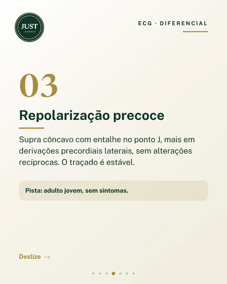 Repolarização precoce: supra de ST côncavo com entalhe no ponto J, sem alterações recíprocas
